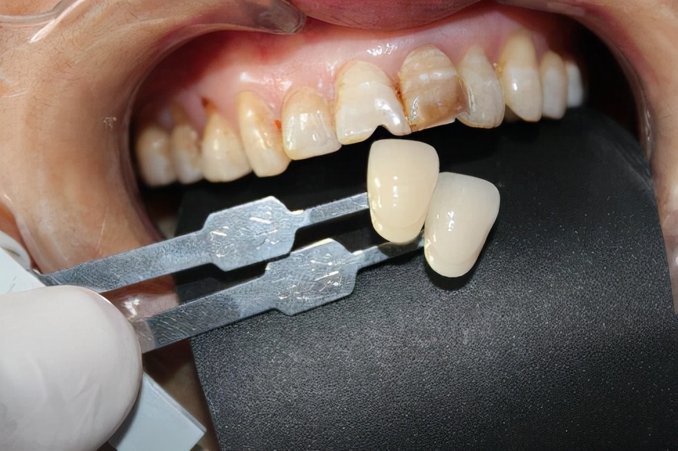 大部分牙缺失怎么装假牙,全口没牙要佩戴哪种活动假牙好