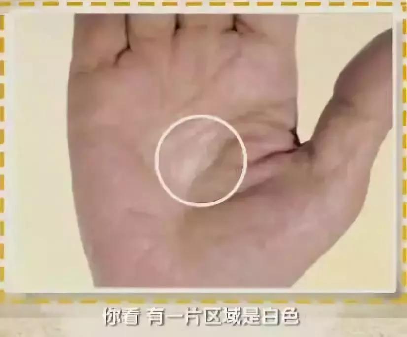 手健康有多重要,手型看健康