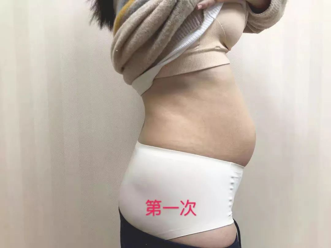 腹直肌分离三年康复的妈妈,腹直肌分离的宝妈们需要注意什么