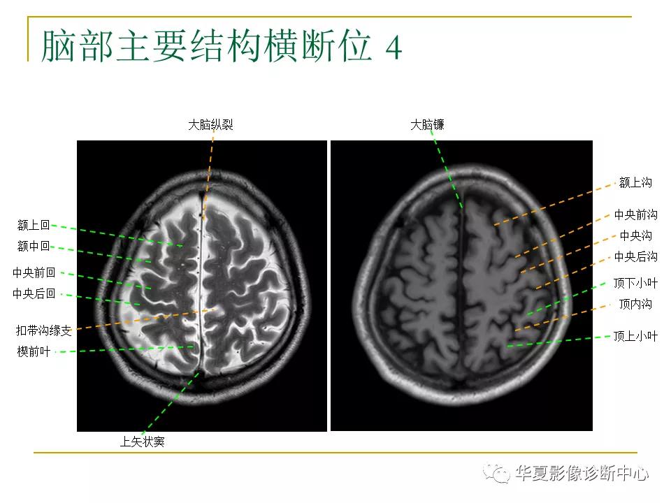 中国人脑立体定向mri应用解剖图谱,脑mri示意图