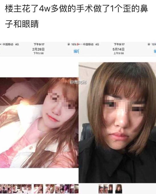 网红抽脂去世真的是意外,网红去抽脂