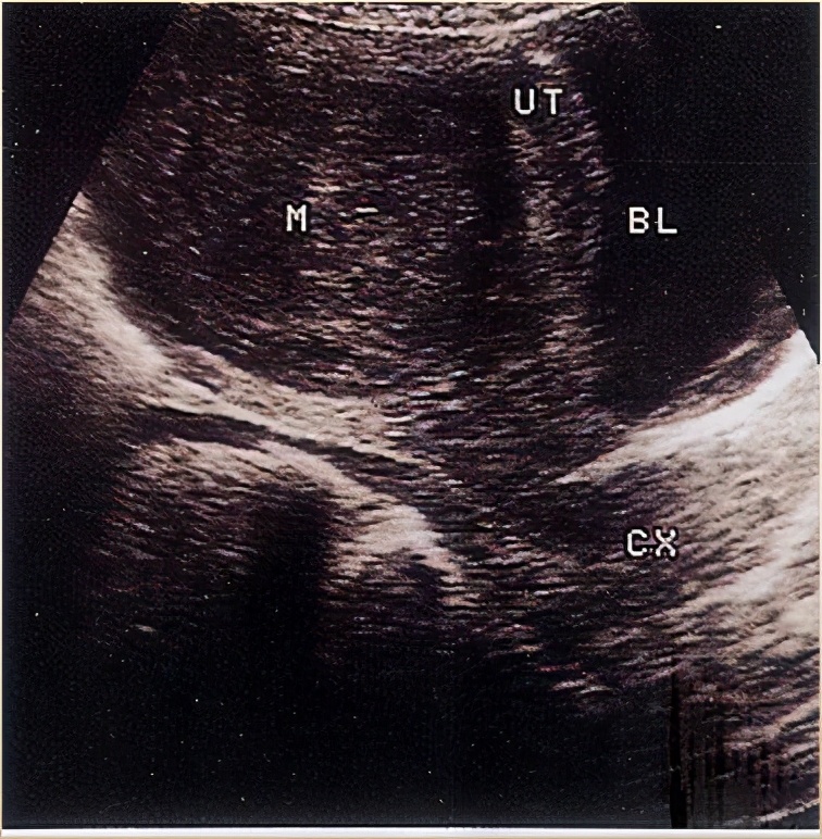 子宫肌瘤切除好还是不切除,子宫肌瘤切不切有什么影响