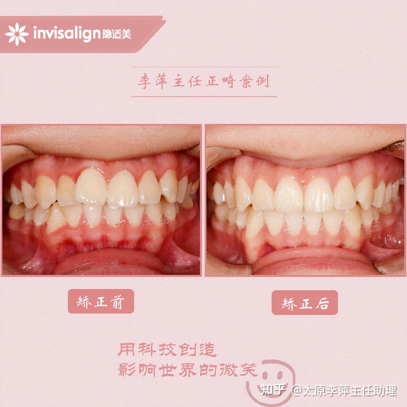 太原牙齿矫正靠谱吗,太原成人隐形牙套牙齿不齐