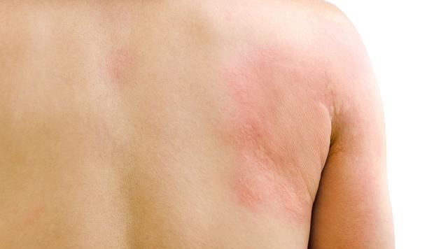 慢性顽固性皮肤湿疹荨麻疹治疗,湿疹荨麻疹神经性皮炎能根治吗