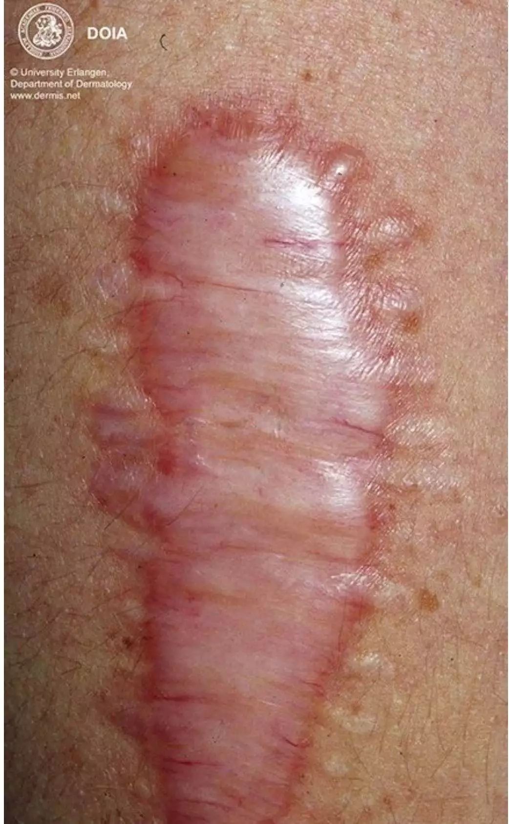 受伤了怎么处理最有效,受了伤留了疤如何去