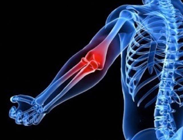 肘关节僵硬手术松解后一直有积液,肘关节僵硬异位骨化必须做松解吗