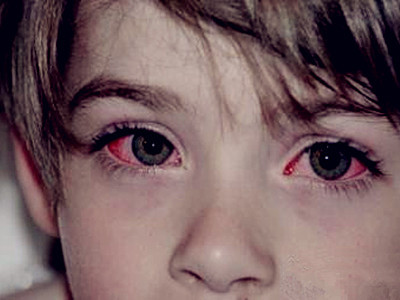 宝宝结膜炎怎么治疗最快最有效,宝宝结膜炎症状和表现怎么治疗