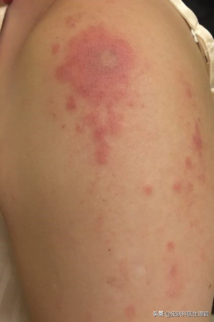 隐翅虫皮炎的危害有哪些,隐翅虫皮炎发痒是什么原因