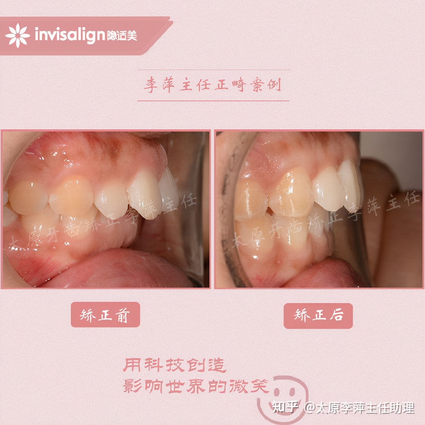 太原牙齿矫正靠谱吗,太原成人隐形牙套牙齿不齐