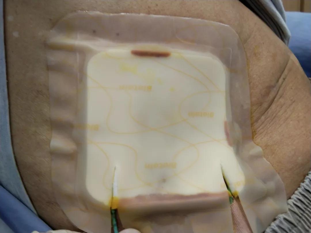 拜尔坦泡沫敷料能促进伤口愈合吗,什么样的病人应该用泡沫敷料