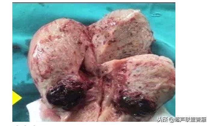 剖宫产疤痕妊娠几率,剖宫产疤痕妊娠及其护理