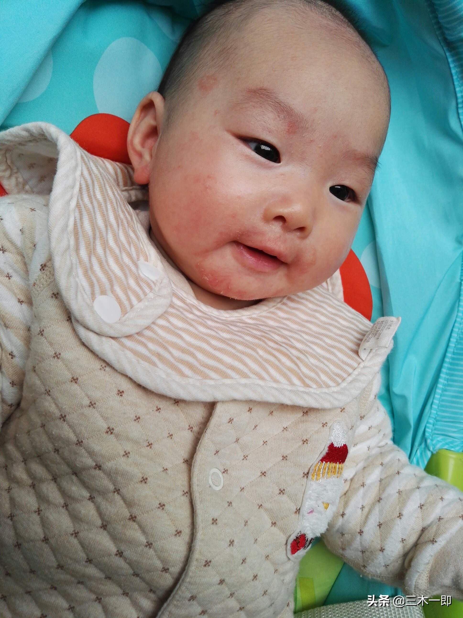 湿疹怎样做好日常预防护理,儿童湿疹反复发作三招教你搞定