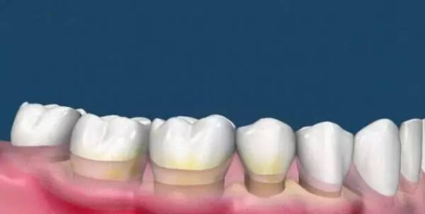 洗牙到底怎么洗好,洗牙洗的不干净