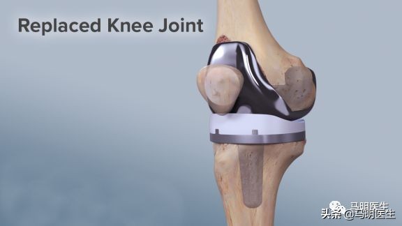 膝关节骨性关节炎治疗指南2018,膝关节骨性关节炎循证医学指南