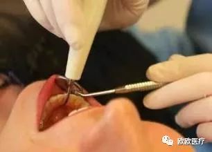 拔牙打麻药对身体有副作用吗,儿童拔牙打麻药对大脑有损害吗