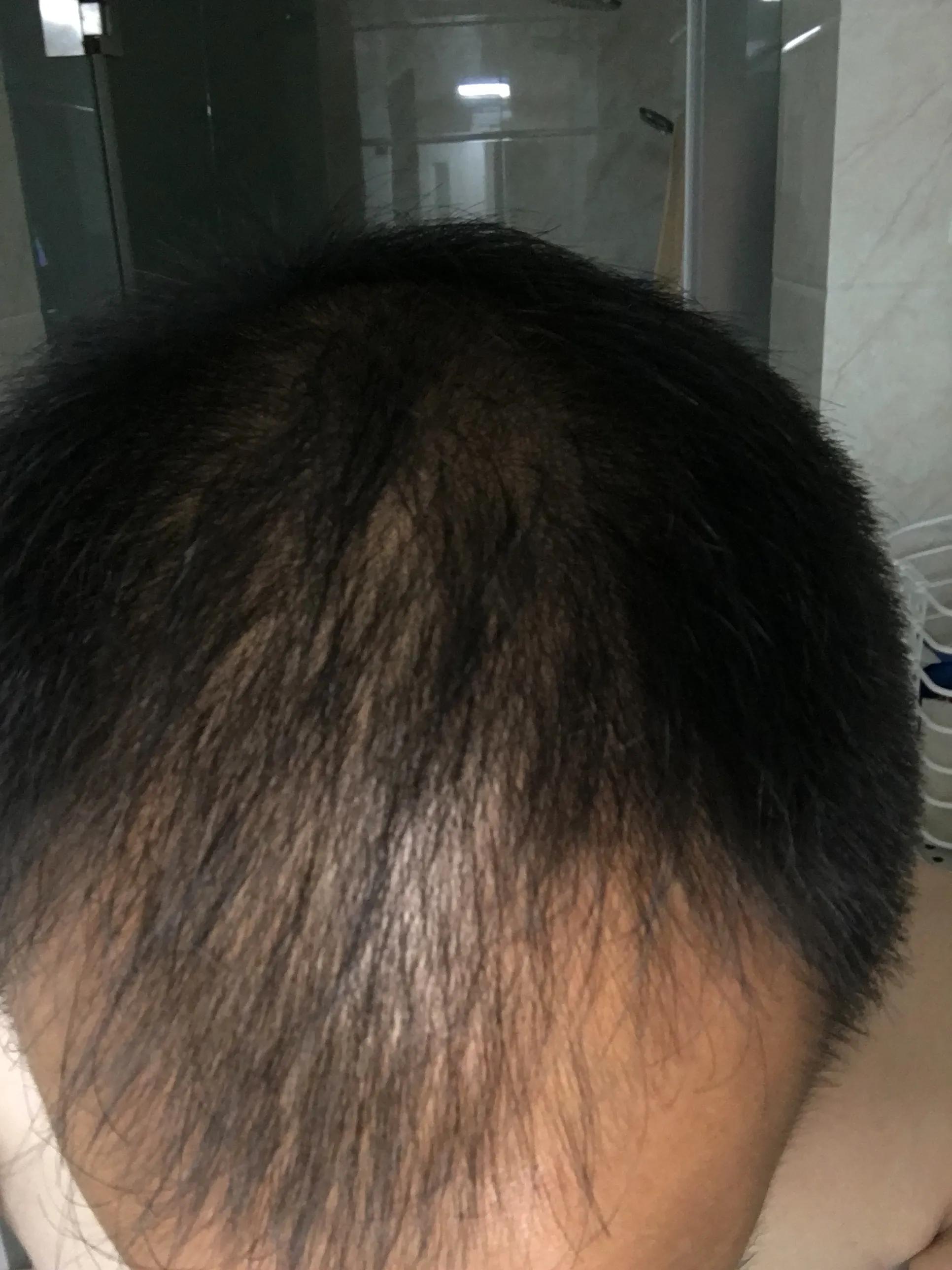 脂溢性脱发的治疗费用,脂溢性脱发的治疗方式