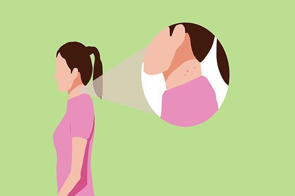 脖子腋下长小肉粒用什么药,脖子腋窝上长小肉粒可以剪掉吗
