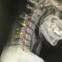 过山车导致脖子不舒服怎么办,女孩玩过山车意外变成了怪物