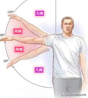 什么原因引起肩周炎手臂活动受限,引起肩周炎疼痛是什么原因