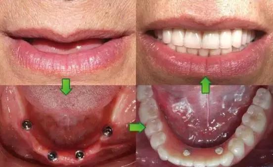 全口牙种植修复视频及注意的事项