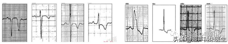 t波倒置诊断,t波倒置如何区分严重程度