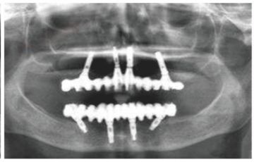 满口缺牙如何补牙,满口缺牙怎么办