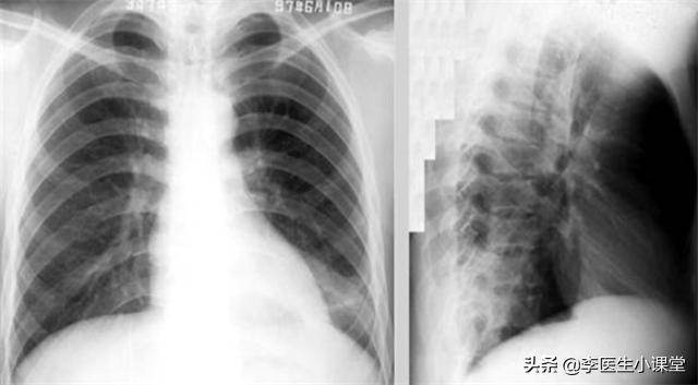 阿莫西林虽然是好药，但只适用于这5类疾病，可别随意乱吃