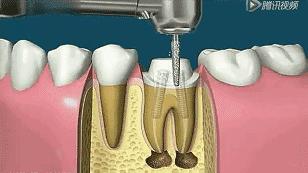 根管治疗第四步骤,根管治疗案例分享话术