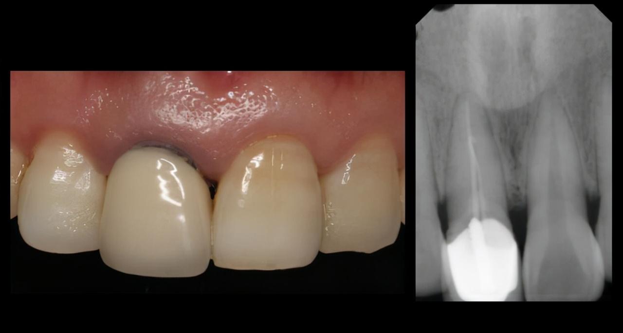 孩子摔一跤嘴唇里面裂了,孩子在学校摔断门牙怎么办