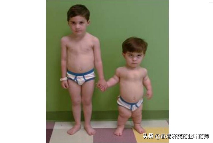 儿童骨骼发育不全能治好吗,软骨发育不良治疗专家共识