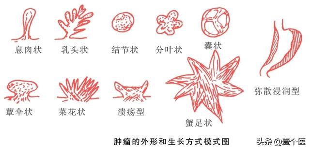 病理单上的癌前病变、非典型性增生及原位癌还是傻傻分不清？