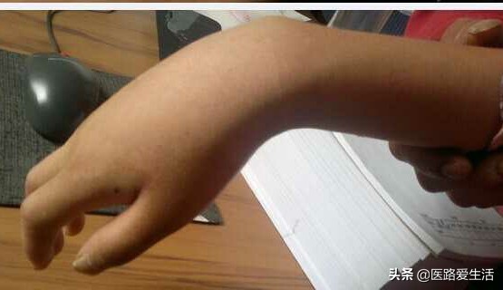 治疗神经损伤的膏药,治疗神经损伤的药