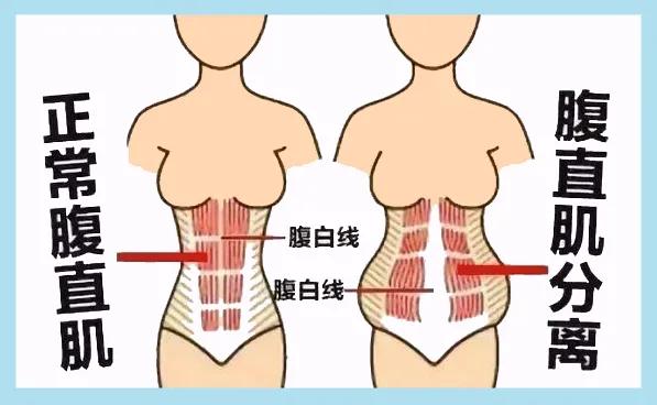 生娃肚皮撑大了怎么恢复,生娃后腰侧赘肉怎么减