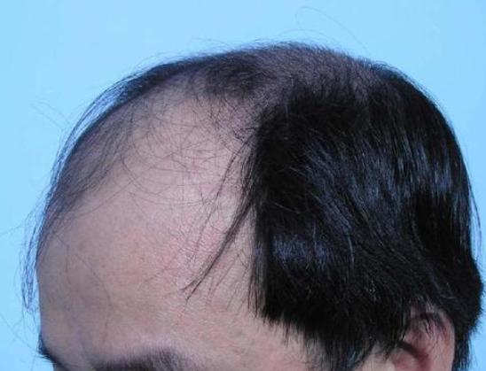 植发后脱落头发根部黑,几年前植发现在原来的头发掉了