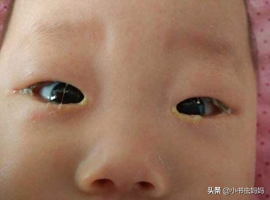 宝宝有眼屎就是上火怎么办,宝宝有眼屎是哪里上火了怎么办