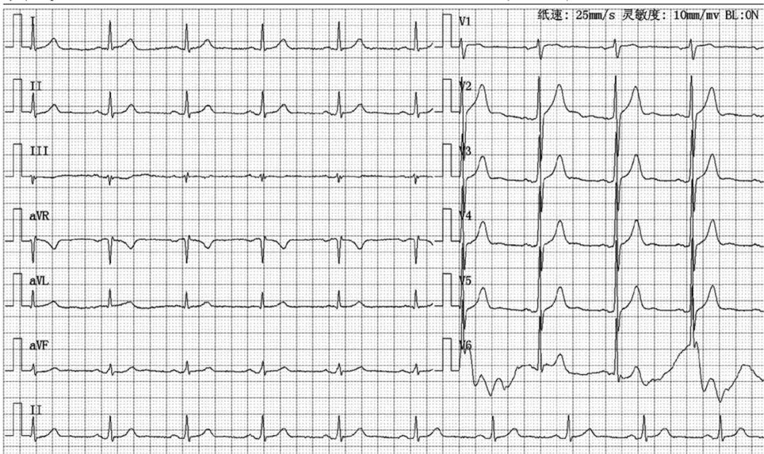 心肌梗死两年心电图正常怎么回事,心电图检查心肌梗死心肌酶正常
