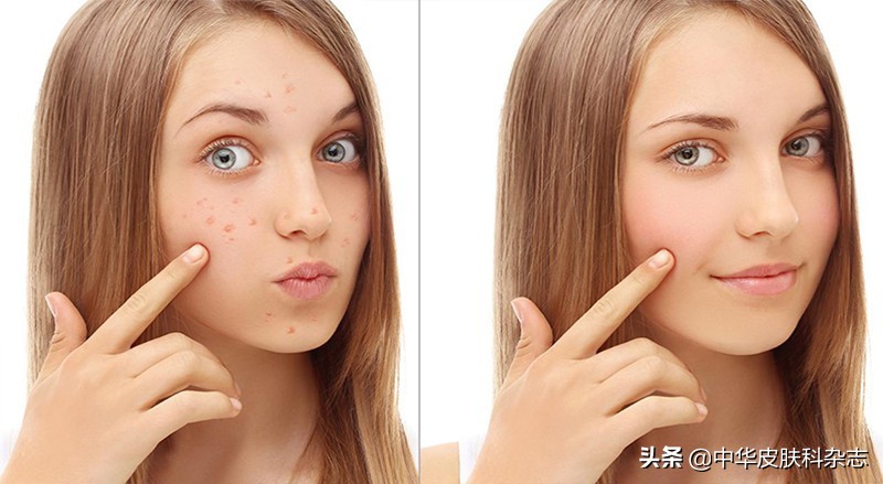 红蓝光治痘痘,照光治疗痘痘