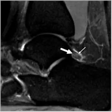 踝关节撞击症问诊,踝关节内侧撞击综合症位置图