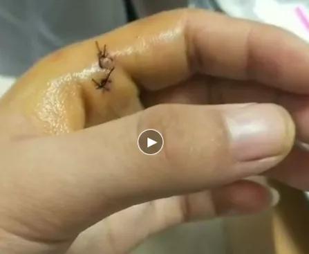 关于曲颈易折安瓿瓶划伤左手的思考