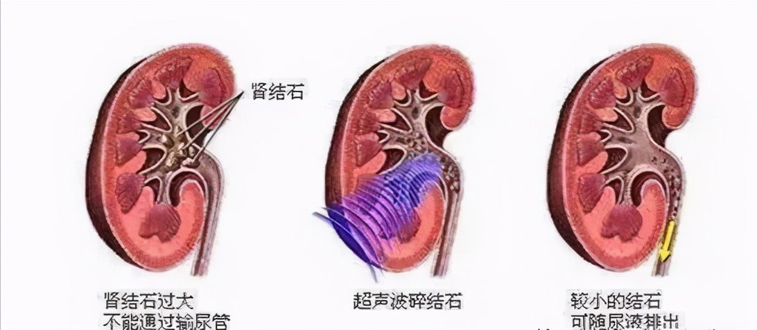 体检查出有肾结石要注意什么,查出有肾结石要注意什么