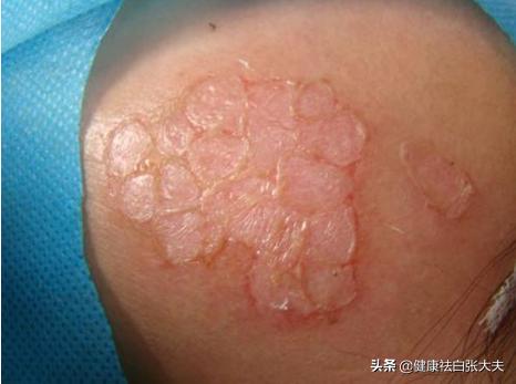 这几种治疗白癜风的偏方你试过没,得了白癜风用什么偏方效果最好