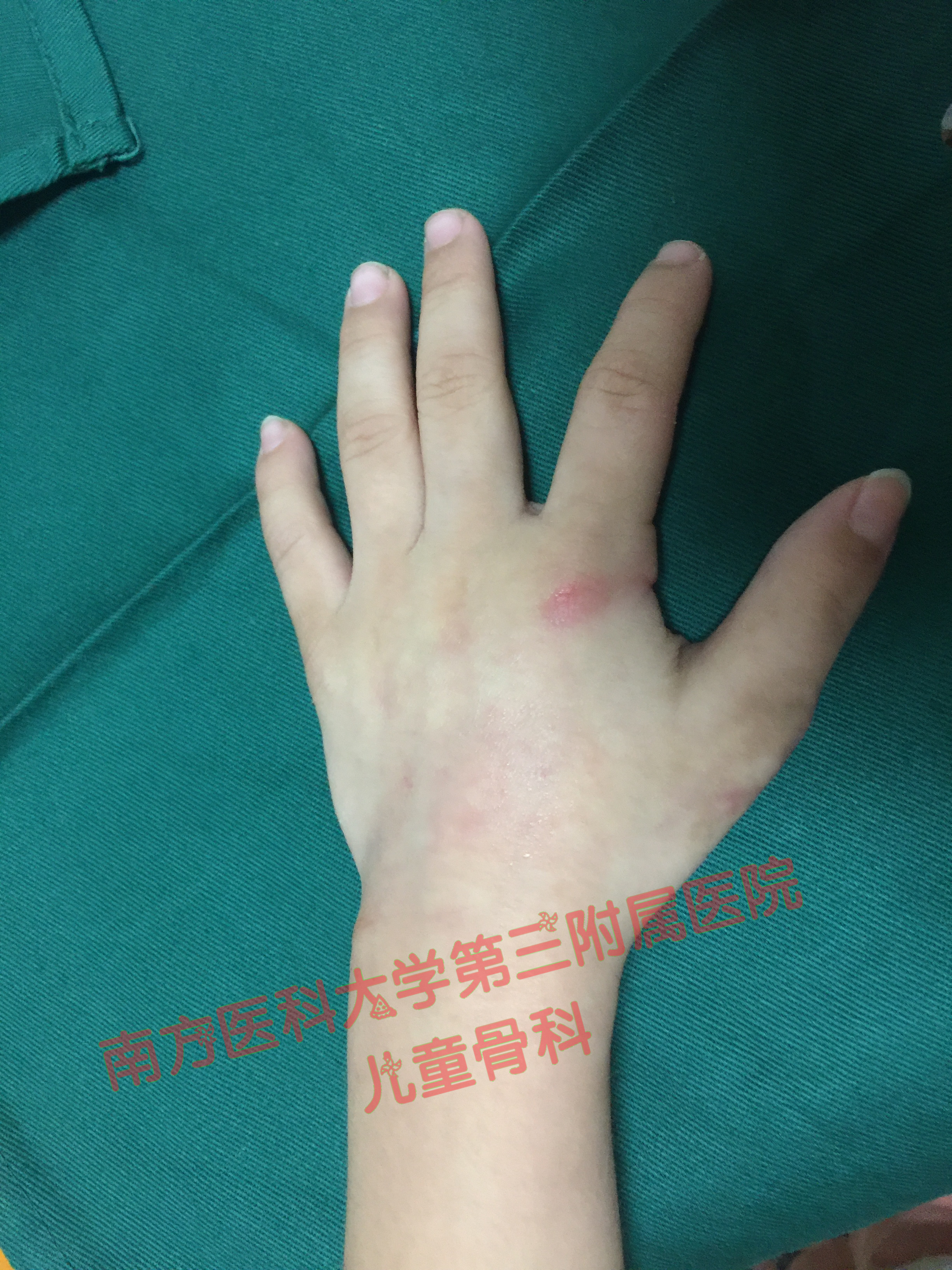 宝宝割并指手术要几天,十几年的缝针手术疤痕怎么淡化