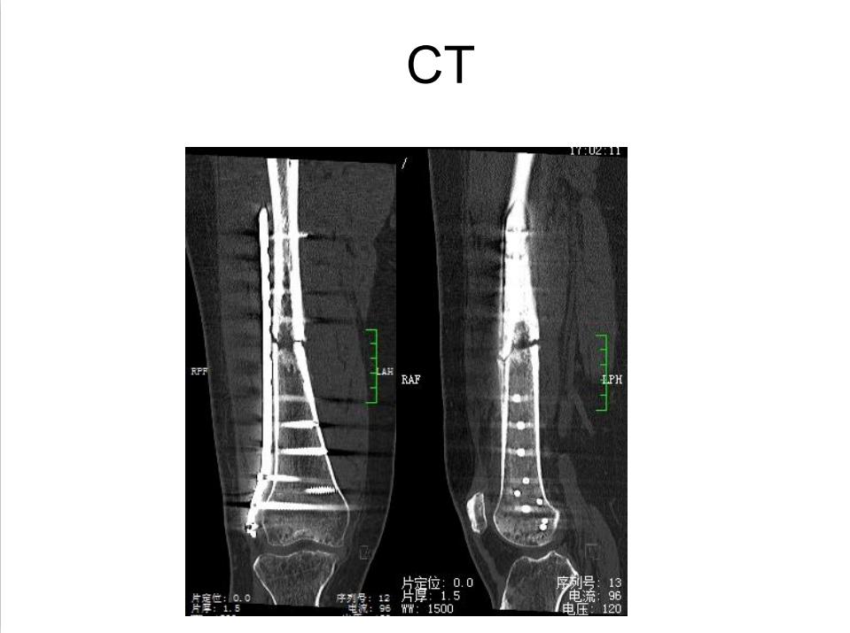 平乐骨科推拿教学,中医治疗骨折畸形愈合