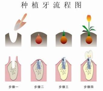 为什么老年人戴假牙嚼不烂鱼肉,老人为什么戴假牙而不种牙