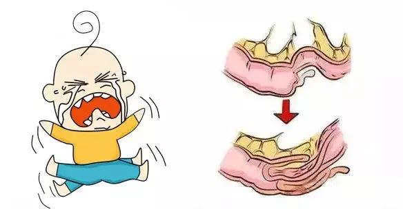 肠套叠和消化不良的区别,孩子肚子胀是着凉还是消化不好