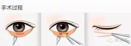 北大整形教授张宗学,全国有名的眼袋整形专家