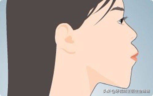 龅牙可以自己按压恢复吗,牙齿龅牙矫正的最佳年龄是几岁