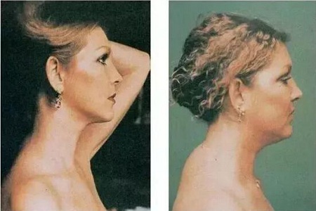 脖子后面颈椎有个鼓包怎么办,颈椎大包怎样通过锻炼来恢复