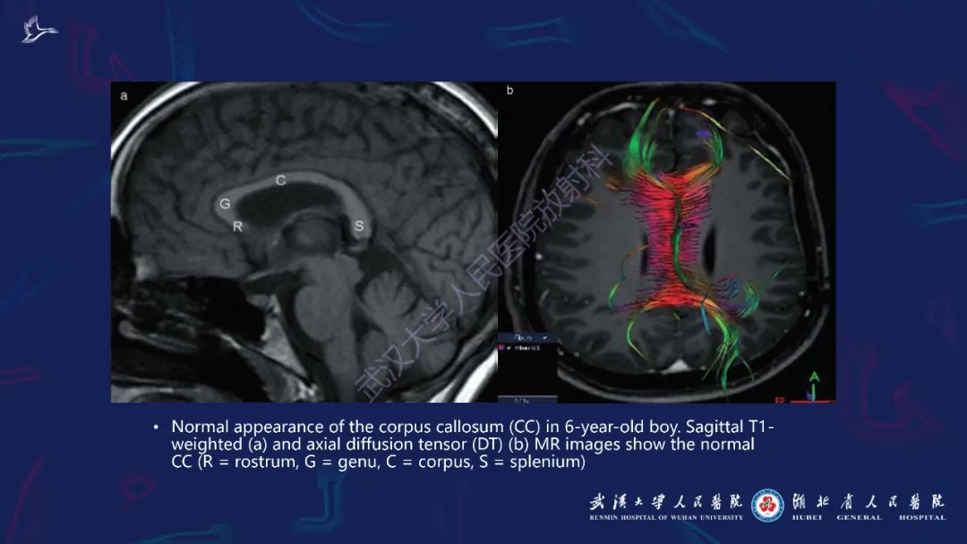 胼胝体肿瘤影像鉴别,胼胝体病变影像诊断