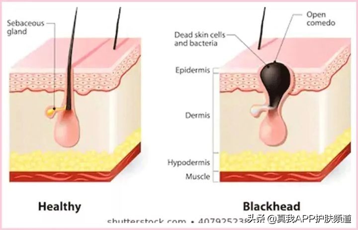 毛孔粗大黑头多脸爱出油怎么解决,毛孔粗大有黑头适合用什么洗面奶